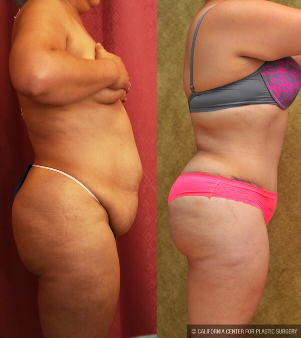 Tummy Tuck (Abdominoplasty) Plus Size Before & After Patient #12654