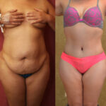 Tummy Tuck (Abdominoplasty) Plus Size Before & After Patient #12654