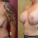 Breast Lift - Full Before & After Patient #12638