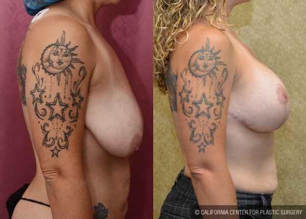 Breast Lift - Full Before & After Patient #12638