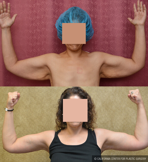 Arm Lift (Brachioplasty) Before & After Patient #12635