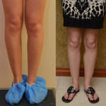 Calf Augmentation Before & After Patient #12620