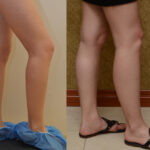 Calf Augmentation Before & After Patient #12620