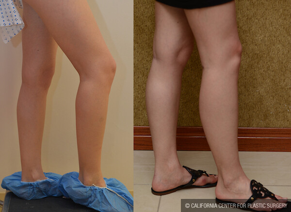 Calf Augmentation Before & After Patient #12620