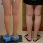 Calf Augmentation Before & After Patient #12620