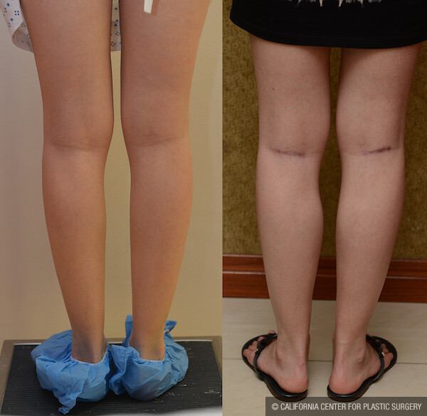 Calf Augmentation Before & After Patient #12620