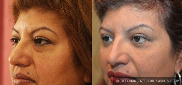 Eyelid (Blepharoplasty) Before & After Patient #12615