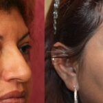 Eyelid (Blepharoplasty) Before & After Patient #12615