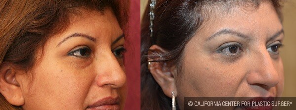 Eyelid (Blepharoplasty) Before & After Patient #12615