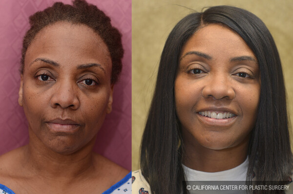 Mid-Facelift Before & After Patient #12610