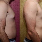 Male gynecomastia (breast) reduction Before & After Patient #12606