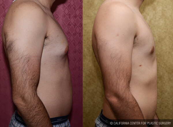 Male gynecomastia (breast) reduction Before & After Patient #12606