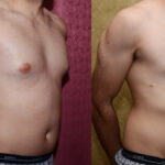 Male gynecomastia (breast) reduction Before & After Patient #12606