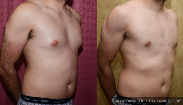 Male gynecomastia (breast) reduction Before & After Patient #12606