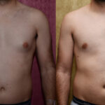 Male gynecomastia (breast) reduction Before & After Patient #12606