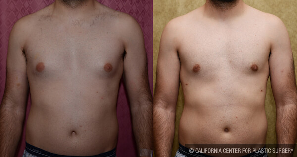 Male gynecomastia (breast) reduction Before & After Patient #12606