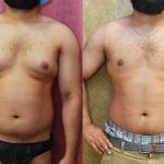 Male gynecomastia (breast) reduction Before & After Patient #12658