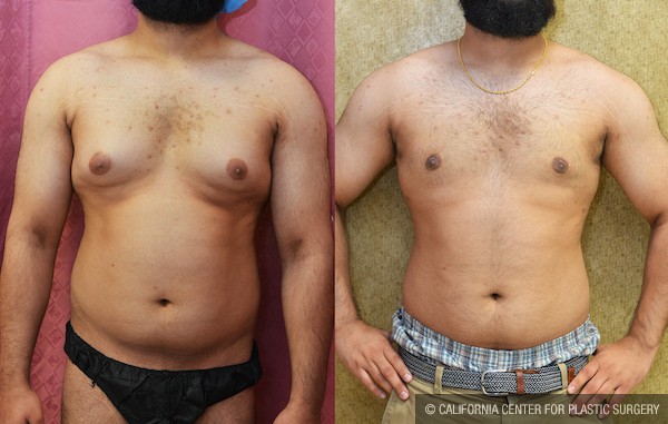 Male gynecomastia (breast) reduction Before & After Patient #12658