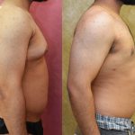 Male gynecomastia (breast) reduction Before & After Patient #12658