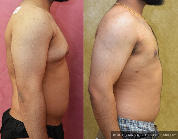 Male gynecomastia (breast) reduction Before & After Patient #12658