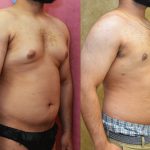 Male gynecomastia (breast) reduction Before & After Patient #12658