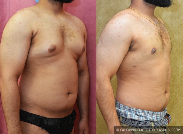 Male gynecomastia (breast) reduction Before & After Patient #12658