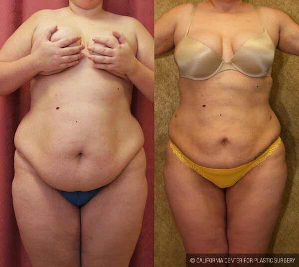 Liposuction Abdomen Plus Size Before & After Patient #12585