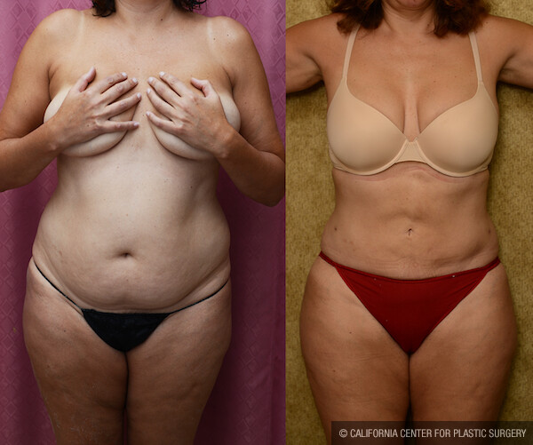 Liposuction Abdomen Medium Before & After Patient #12597