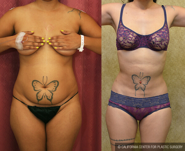 Liposuction Abdomen Medium Before & After Patient #12593