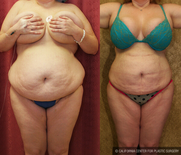 Liposuction Abdomen Plus Size Before & After Patient #12589