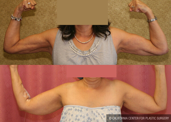 Liposuction Arms Before & After Patient #12582