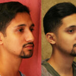 Male Rhinoplasty Before & After Patient #12570