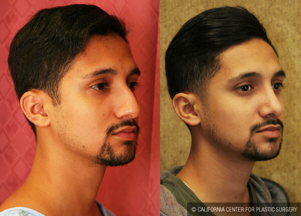 Male Rhinoplasty Before & After Patient #12570