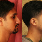 Male Rhinoplasty Before & After Patient #12570