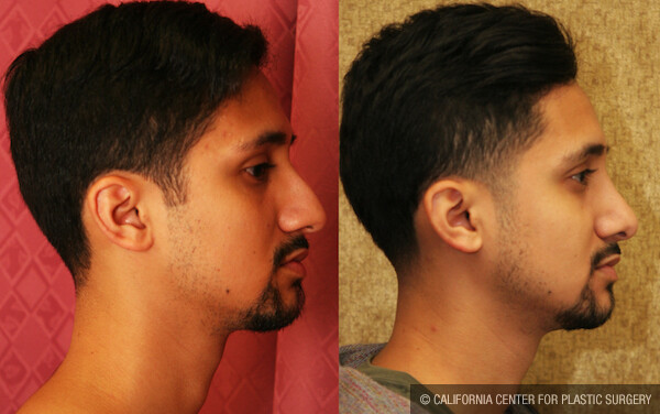 Male Rhinoplasty Before & After Patient #12570