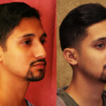 Male Rhinoplasty Before & After Patient #12570