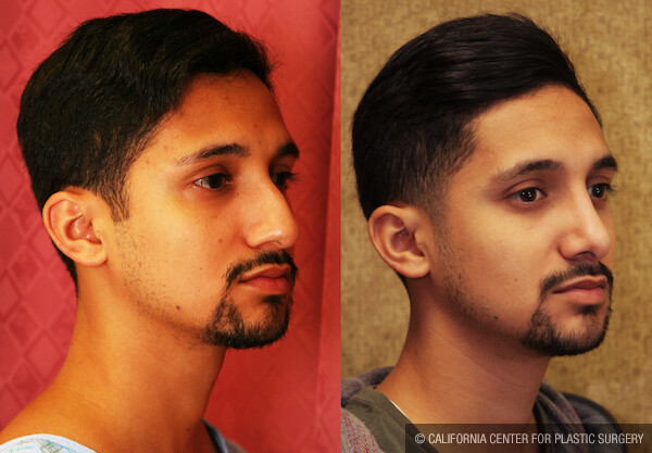 Male Rhinoplasty Before & After Patient #12570