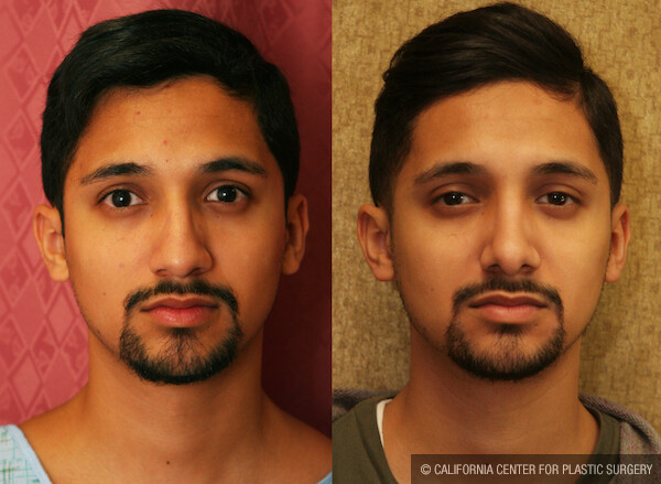 Male Rhinoplasty Before & After Patient #12570