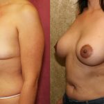 Breast Lift - Moderate Before & After Patient #12725