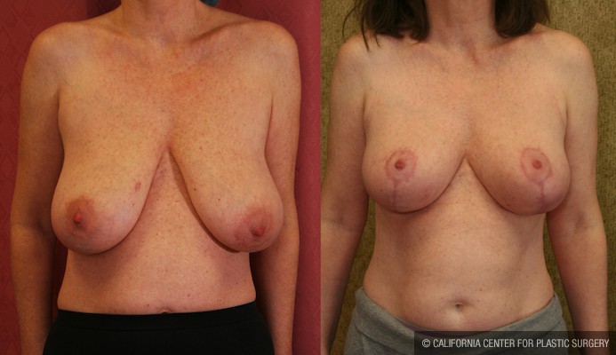 Full Breast Lift Before & After Patient #12730