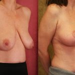Breast Lift - Full Before & After Patient #12730