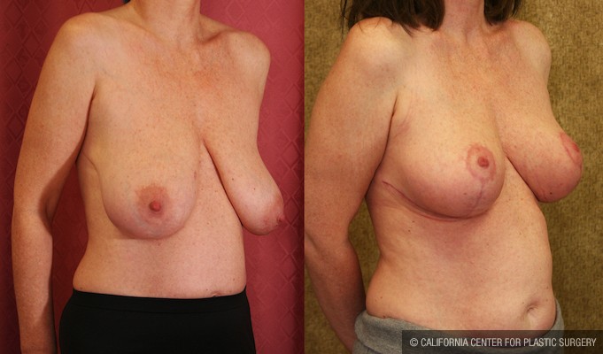 Breast Lift - Full Before & After Patient #12730