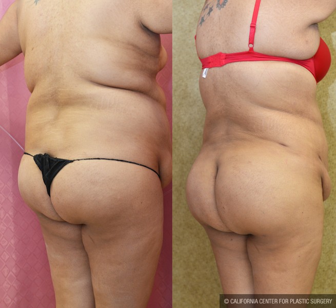 Buttock Lift/Augmentation Before & After Patient #12742