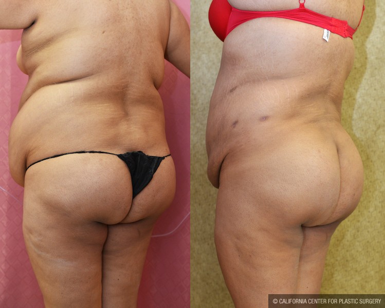 Buttock Lift/Augmentation Before & After Patient #12742