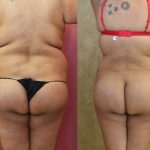 Buttock Lift/Augmentation Before & After Patient #12742