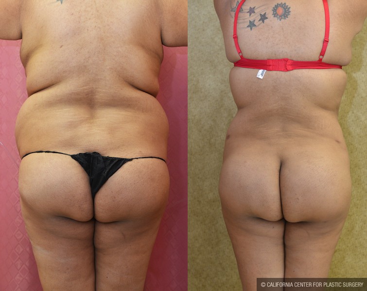 Buttock Lift/Augmentation Before & After Patient #12742