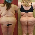 Buttock Lift/Augmentation Before & After Patient #12747