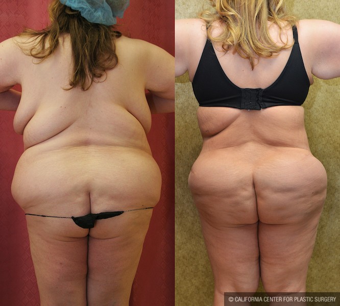 Buttock Lift/Augmentation Before & After Patient #12747