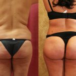 Buttock Lift/Augmentation Before & After Patient #12749