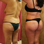 Buttock Lift/Augmentation Before & After Patient #12749